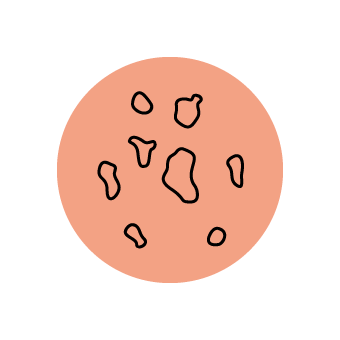 Pigmented Mole & Age Spots Pigmented Mole & Age Spots