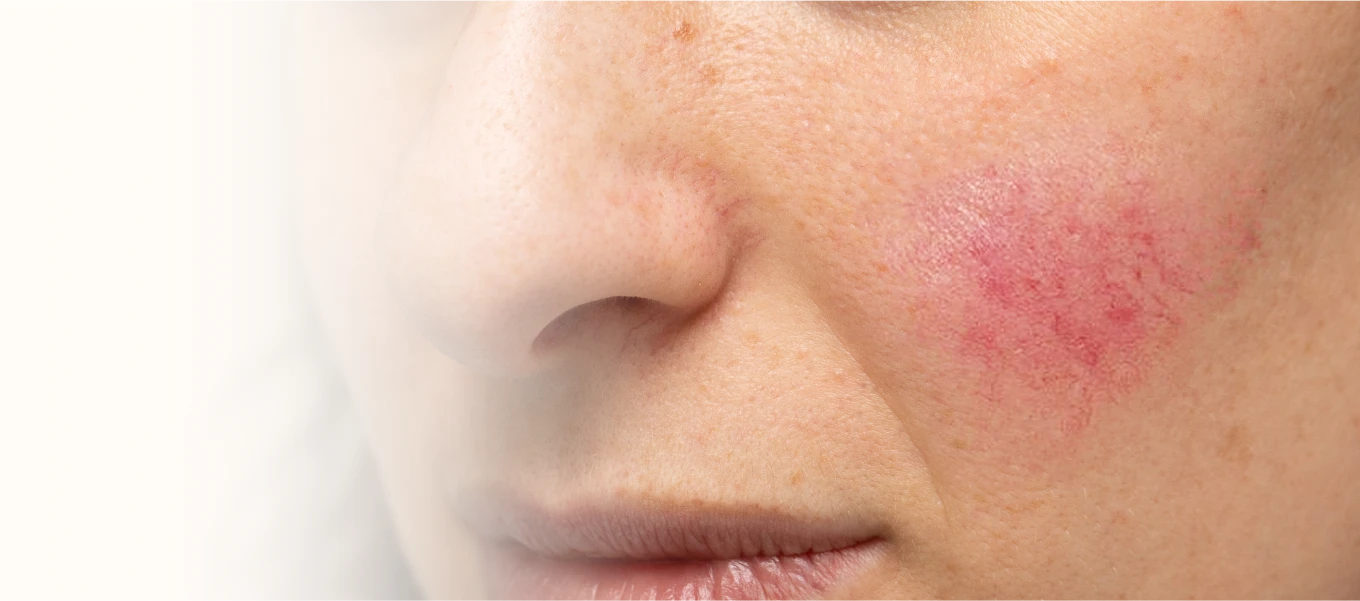 couperose_rosacea_pflege