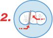 Application patches anti-aureoles étape 2 Application patches anti-aureoles étape 2